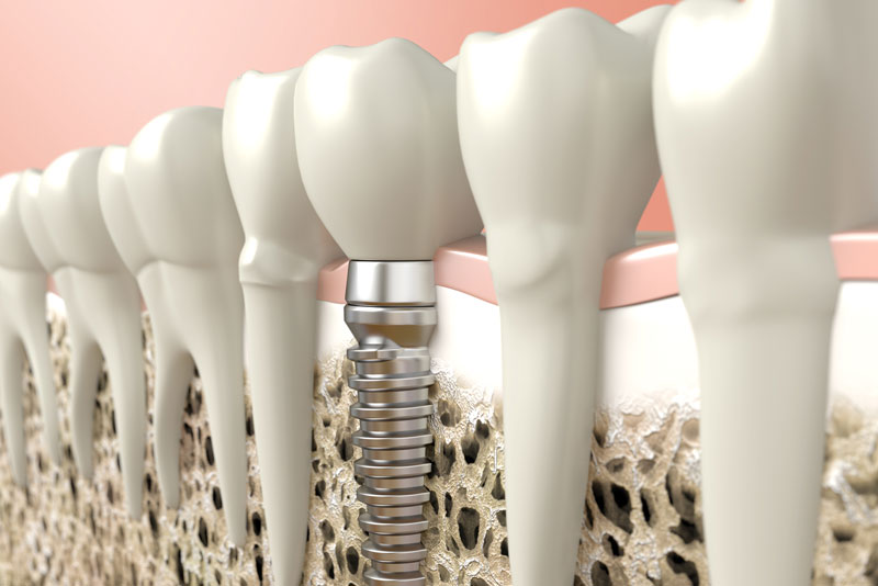 an image of a dental implant.